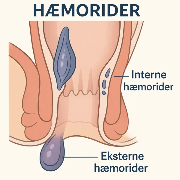 stadier af hæmorider