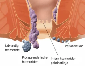 hæmoride eller kræft