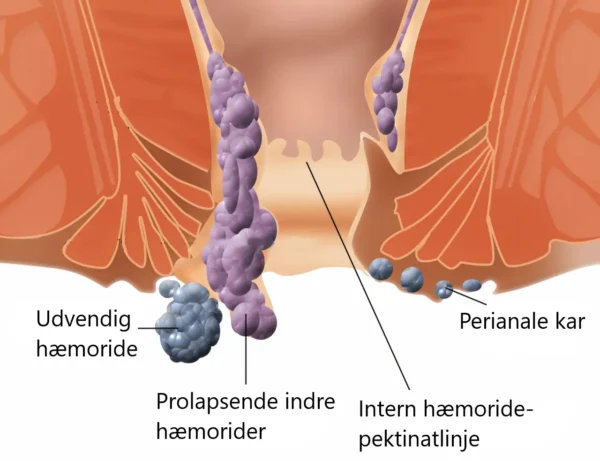 hæmoride eller kræft
